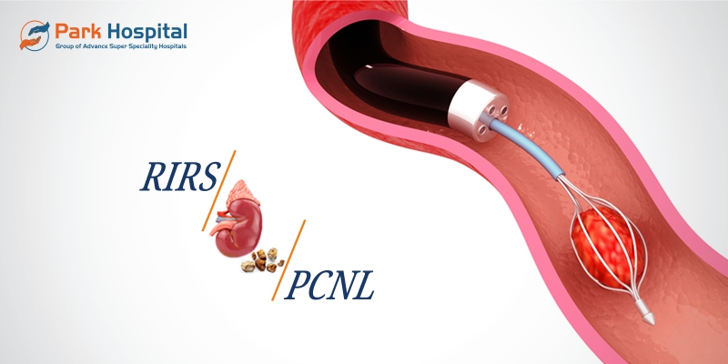 Kidney Stone Surgery Procedure- RIRS V/s PCNL